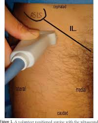 The lateral cutaneous nerve of the thigh (also called the lateral femoral cutaneous nerve) is a cutaneous nerve that innervates the skin on the lateral part of the thigh. Pdf Ultrasound Imaging Accurately Identifies The Lateral Femoral Cutaneous Nerve Semantic Scholar