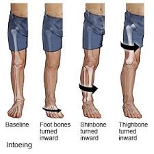 Image result for In-Toeing