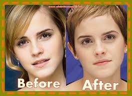 Emma Watson Plastic Surgery Nose Job Rhinoplasty Surgeons Rumors Rhinoplasty Surgeon Nose Job Rhinoplasty