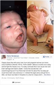 Herpes simplex virus (hsv) is a virus that causes infections. Alarming Fact Your Kiss Can Hurt A Baby