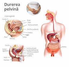 Durerea PelvinÄƒ Romedic
