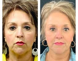 Facial Liposuction in Albuquerque