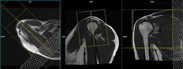 Image result for Shoulder MRI