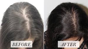 Here S How To Stop Hair Loss And Grow Your Hair Fast Hairlosswomenstress Fast Grow Hair Hairlosswo Hair Loss Treatment Stop Hair Loss Natural Hair Loss