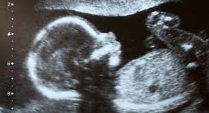 If you're sick of being single, it's time to download one of the best dating apps for 2021. Anomaly Scan Tiffa Or Ultrasound Level Ii Scan Babycenter India