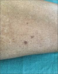 Image result for Pigment stains on the shin
