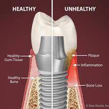 Gum Disease Is Still A Threat To Your Dental Implants Haslet Family Dentistry