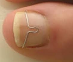 Transpiration excessive, chaussures trop serrées, traumatisme… les causes de l'ongle incarné sont nombreuses. Bien Couper Ses Ongles De Pied