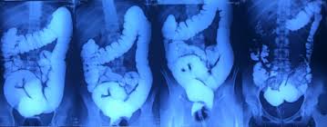 Image result for Chronic Constipation