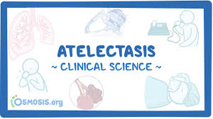 Image result for Atelectasis
