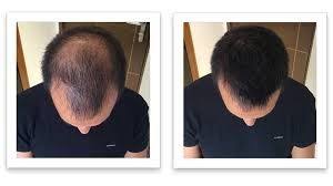You might get it on your scalp from shampoos or other hair products. Patchy Hair Loss On Scalp Reverse Hair Loss From Trt Hair Loss Men Reverse Hair Loss Help Hair Loss