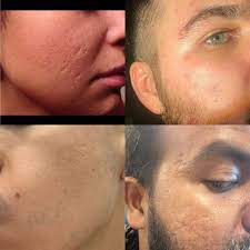 After 24 weeks of treatment with adapalene/benzoyl peroxide gel, atrophic acne scarring and lesions were reduced, and results were maintained after 48 the lack of a control group in the second part of the study was cited as a limitation. Acne Scarring Setting The Record Straight Dermangelo