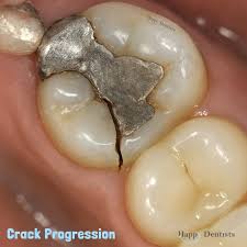 Image result for Tooth Fracture