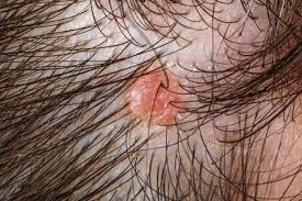 Image result for Seborrheic Dermatitis