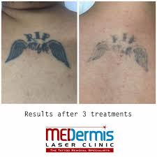 Depending on the size of the tattoo, surgical removal may range between $150 and $350, according to st. Medermis Laser Medermis Twitter