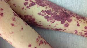 They appear as bleeding occurs under the skin, but is not because of any damage to the blood vessels. Purpura Causes Diagnosis Treatment And Pictures