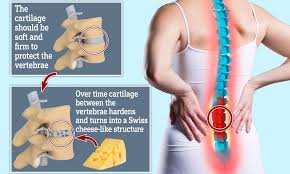 Chest and back pain that occurs during or after eating may be a symptom of one of the following digestive chest and back pain can be a cause for concern, especially if a person has an underlying. Lower Back Pain May Be Caused By Cartilage Turning Into Bone That Looks Like Swiss Cheese Daily Mail Online