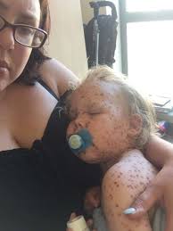 Severe Chicken Pox | Homeopathic | Best Homeopathic Doctor in Pakistan | Dr Qaisar Ahmed MD, DHMS