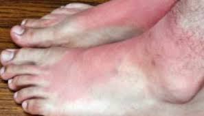 A podiatrist explains why the bottom of your feet may itch, including causes like athlete's foot, psoriasis, cholestasis, bacterial infections and skin cancer. Skins Cancer And Your Feet What You Should Know Foot Surgery In Minnetonka