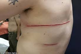 Check out our lightning scar tattoo selection for the very best in unique or custom, handmade pieces from our shops. Tattoo Trend Sees Customers Asking For Scars Instead Daily Mail Online