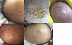 Image result for Tinea Capitis