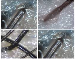 When psoriasis develops on the scalp, hair loss sometimes follows. Scalp Treatment Kimage