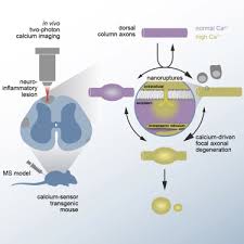 Check spelling or type a new query. Calcium Influx Through Plasma Membrane Nanoruptures Drives Axon Degeneration In A Model Of Multiple Sclerosis Sciencedirect