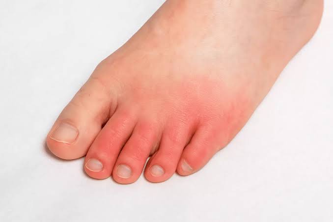 Swelling & Redness in Foot &ndash; Podiatry Care | Freedom Clinics Canary Wharf