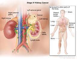 The doctor checks general signs of health and tests for fever and high blood pressure. Kidney Renal Cell Cancer Hematology Oncology Associates Of Cny