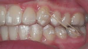 This wire is usually held in place by rubber bands or braided wire called ligatures. Invisalign Rubber Bands Do You Need Them