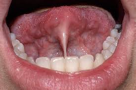 Image result for Ankyloglossia