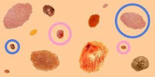 We don't think much about them. Guide To Moles Skin Cancer How To Tell If A Mole Is Cancerous