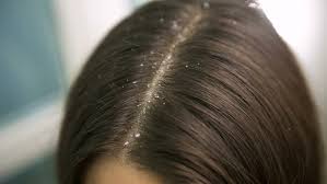 However, the constant scratching and overall inflammation can certainly contribute to thinning. Dandruff