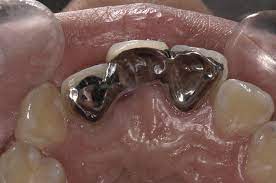 Annapolis fishing parties up to 6 passengers. Occlusal View Of The Early Completed Anterior Maryland Bridge Download Scientific Diagram