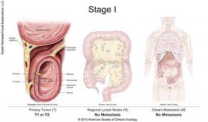 How do colon cancer patients find out about it? View All Pages Cancer Net