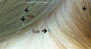 Image result for lice vs nits