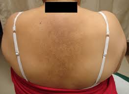 Image result for Notalgia Paresthetica