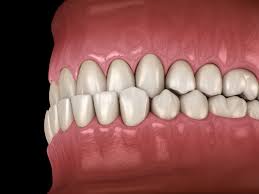 This is a fixed or removable orthodontic appliance that is used to make the upper jaw wider. Overbite Underbite And Crossbite What Do These Bite Disorders Mean