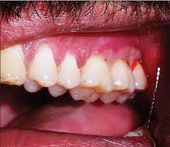 Herpes simplex virus two further conditions, seen especially in children, are herpetic gingivostomatitis and herpetic whitlow. Acute Herpetic Gingivostomatitis Associated With Herpes Simplex Virus 2 Report Of A Case Abstract Europe Pmc