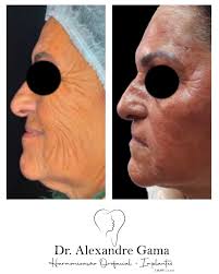 Rejuvenescimento Facial. Microagulhamento associado ao iPRF (Agregados  Plaquetários Autólogos) Foto: Pós imediato Dr. Alexandre Gama Especialista  em Harmonização Orofacial Crosp: 55.231 . . . . . #iprf #iprffacial  #microagulhamento #harmonizacaofacial ...