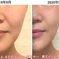 美エイジレス塾 nana ほうれい線が薄くなってお顔が引き締まった４２歳のmさん美魔女ママのビフォーアフター写真 美容ブログ 美肌 スキンケア エイジレス