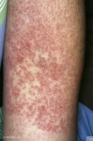 Incidence of rash after amoxicillin treatment in children with infectious mononucleosis 17. Mononukleose Infektiose Altmeyers Enzyklopadie Fachbereich Dermatologie