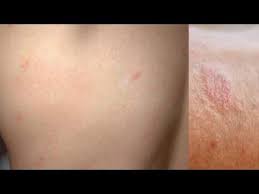 Bicarbonatul de sodiu (nahco3) este un compus chimic anorganic care face parte din categoria sărurilor. Se Spune Ca Pitiriazisul Nu Are Leac Este Adevarat Youtube