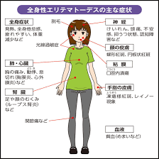 女性に多い全身性エリテマトーデス 多彩な症状 臓器障害も 暗算 症状 妊娠 出産