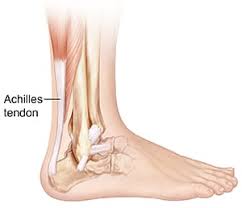 Achilles tendon pain, also called achilles tendonitis or tendonosis, is the result of stiffness, swelling and tearing of connective tissue located around the heel and the sides of the ankle. Achilles Tendonitis Treatment In Sydney Heel Clinic