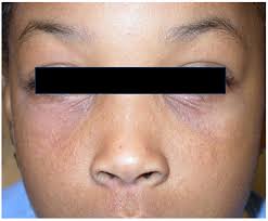 Image result for Atopic Patient