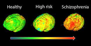 Brain's immune cells hyperactive in schizophrenia | Neuroscience | The  Guardian
