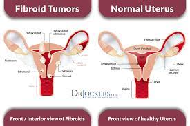 Will it help you lose weight? Uterine Fibroids Symptoms Causes And Natural Support Strategies