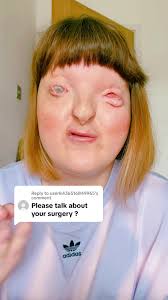 Replying to @user8436516849965 Due to my rare genetic condition Fraser  Syndrome, which means I have an eye condition called Cryptophthalmos, I  have undergone eye removal surgery, and then several ...