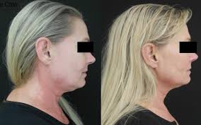 RF Microneedling Treatment in Springfield, MA